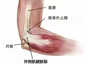 手肘外侧疼、提物没力气？当心！“网球肘” 已盯上你